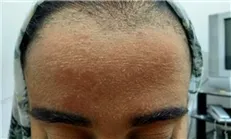 جدال زهرای ۱۷ ساله با بیماری نادر/ بیمه زیر بار هزینه‌های درمان نرفت +شماره حساب برای کمک