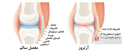 پیاده&zwnj;روی، دوچرخه&zwnj;سواری و شنا راه موثر مقابله با آرتروز