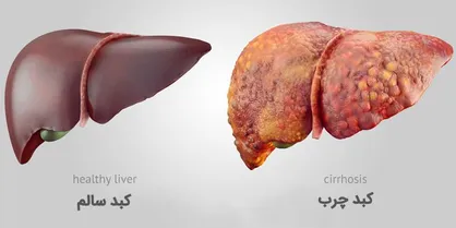 فیلم/ خوراکی&zwnj;هایی که برای کبد چرب ممنوع است