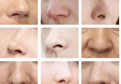 حداقل و حداکثر سن برای انجام جراحی بینی/ شایع&zwnj;ترین عوارض رینوپلاستی را بشناسید