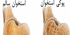 ۲ راهکار اصلی پیشگیری از پوکی استخوان