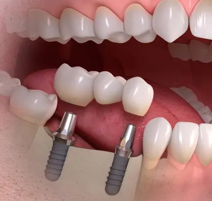 آنچه در مورد کاشت ایمپلنت باید بدانید/ آیا ایمپلنت ضرری هم دارد؟