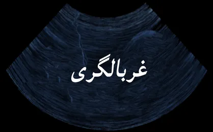 غربالگری