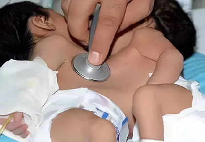 عمل جداسازی دوقلو&zwnj;های به&zwnj;هم&zwnj;چسبیده در شیراز با موفقیت انجام شد