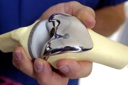 پروتز مفصل کمیاب شد/ کاهش جراحی در بیمارستان&zwnj;های دولتی