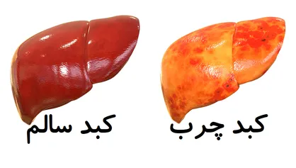 روش&zwnj;هایی برای فرار از کبد چرب